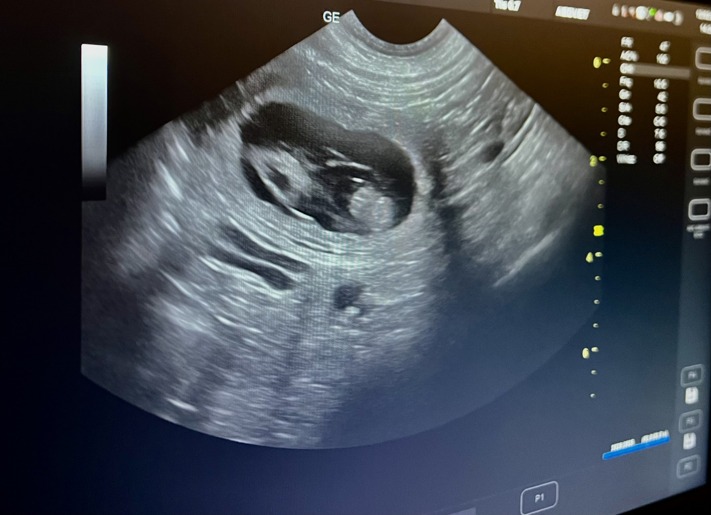 La gestation est confirmée. 